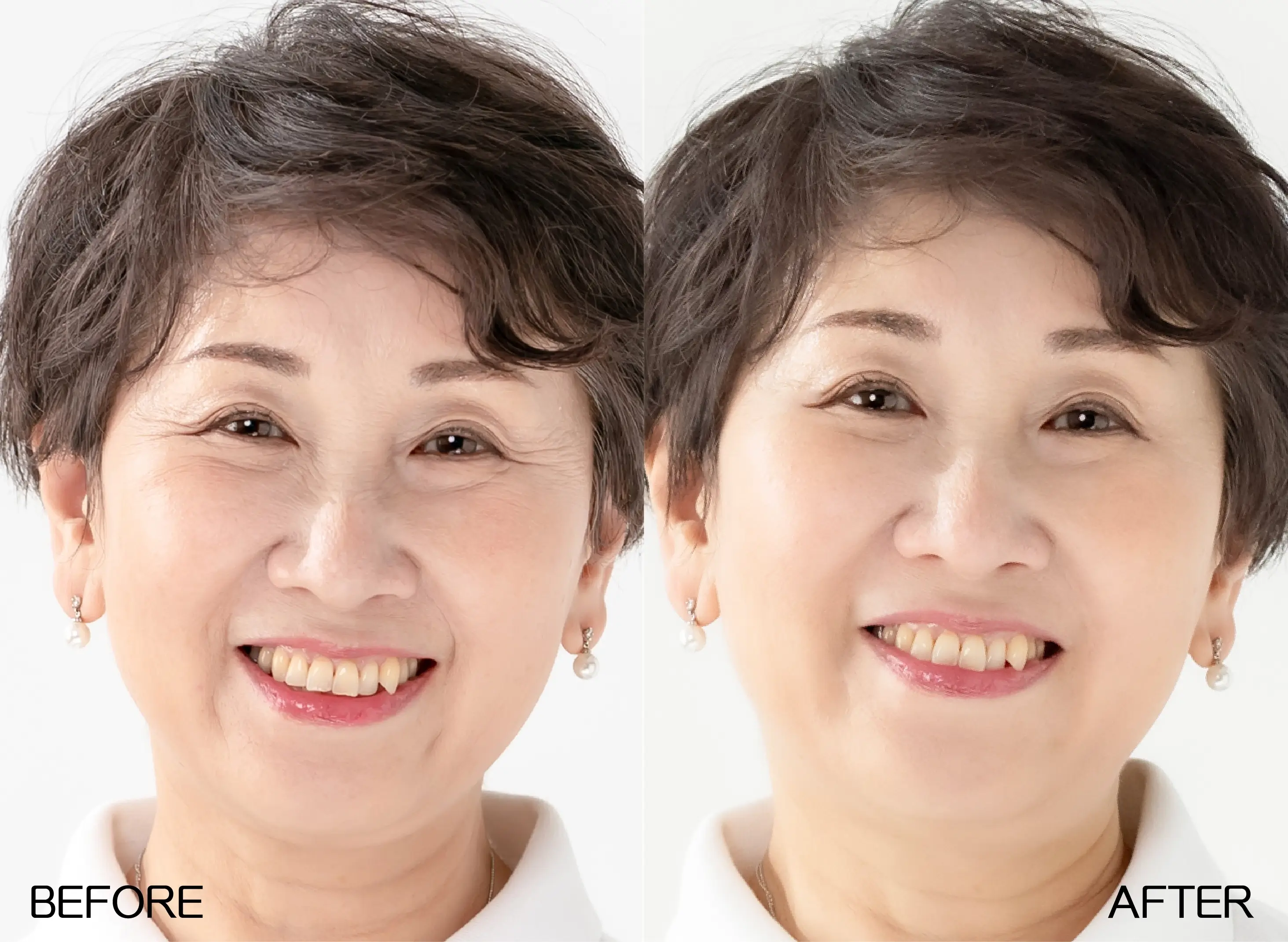 Juvederm喬雅登玻尿酸-撫平深層皺紋前術後對比圖