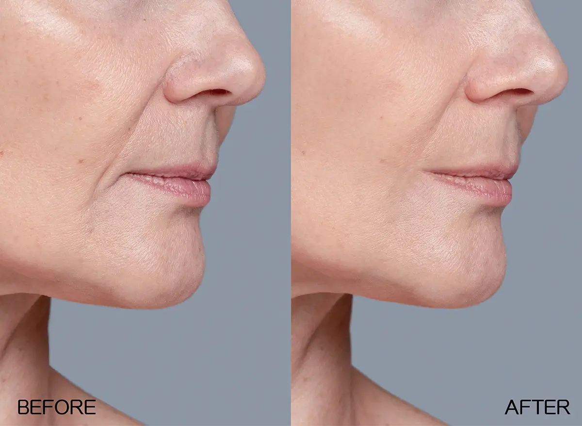 Juvederm喬雅登玻尿酸-嘴角紋填補前術後對比圖